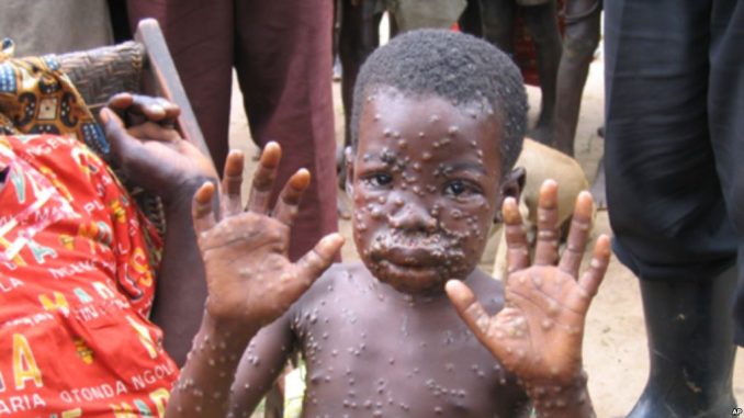 Another State In Nigeria Confirms Two Cases Of Monkey Pox
