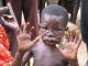 Another State In Nigeria Confirms Two Cases Of Monkey Pox